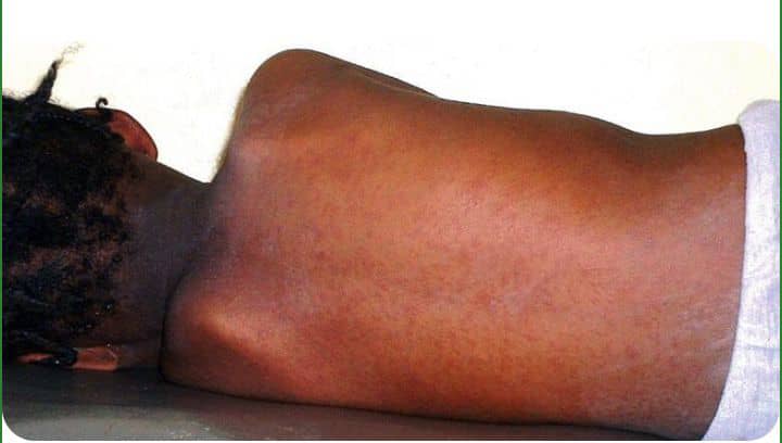 Urgence sanitaire à Mwenga : la rougeole frappe les enfants dans la zone de santé de Kamituga